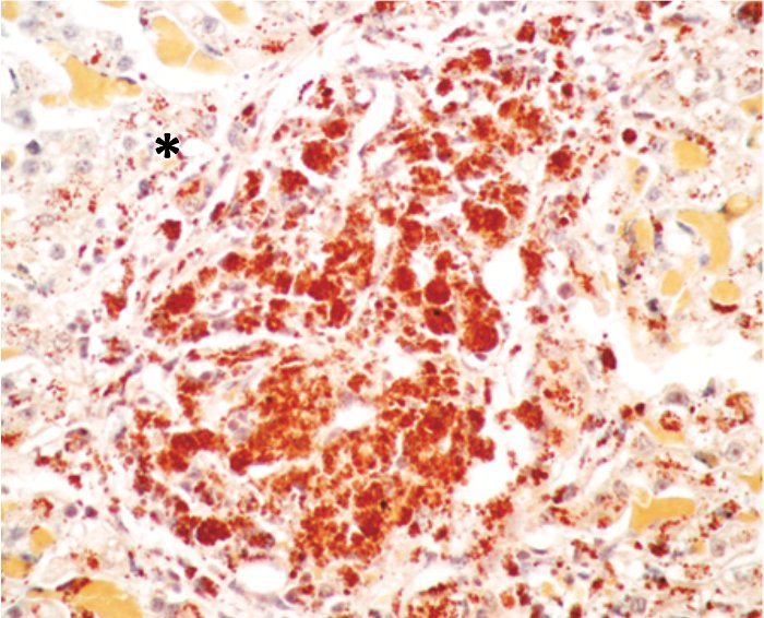 hepatita cauzata de cupru