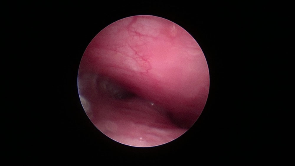 endoscopie-colaps-traheal